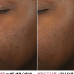 Soin Spécifique Visage|Sérum Et Booster>It Cosmetics Bye Bye Breakout                Sérum anti-acné à l'acide salicylique